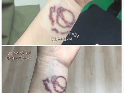 5년동안 타투 지운 후기