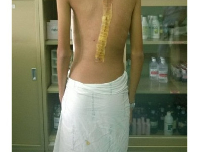 기괴한 척추측만증