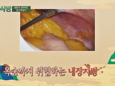 주의) 몸 속에 내장지방 차곡차곡 쌓였을때 모습..gif