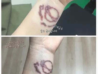 [스압] 5년동안 타투 지운 후기.jpg