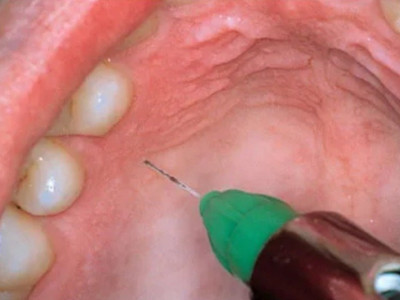 치과에서 가장 아픈 마취.jpg