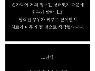 주의) 화상치료 레전드