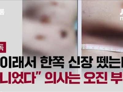 혐주의)적출했는데 암이 아니었다는 의사
