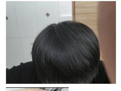 모발이식에 천만원 투자한 결과