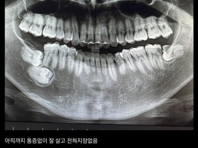 싱글벙글 익스트림 사랑니갤