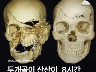 산산조각난 두개골  8시간 수술