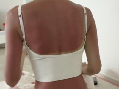 땡볕에 4시간 있다 화상 입은 여성