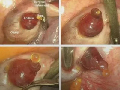 카메라에 포착된 희귀한 인간의 배란 순간