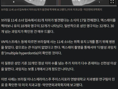 11세 소녀 입 속에 '81개 치아' 발견