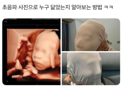 초음파사진으로 누구 닮았는지 알아보는법