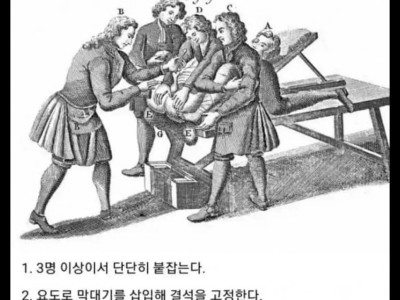 옛날 요로결석 수술법