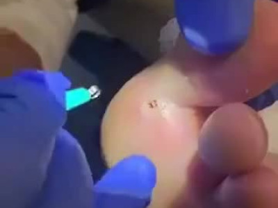 박힌가시 빼는 영상